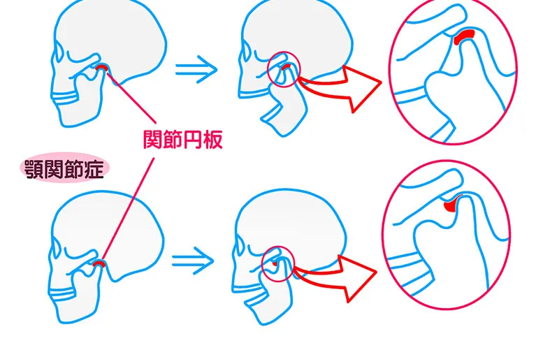 顎関節症